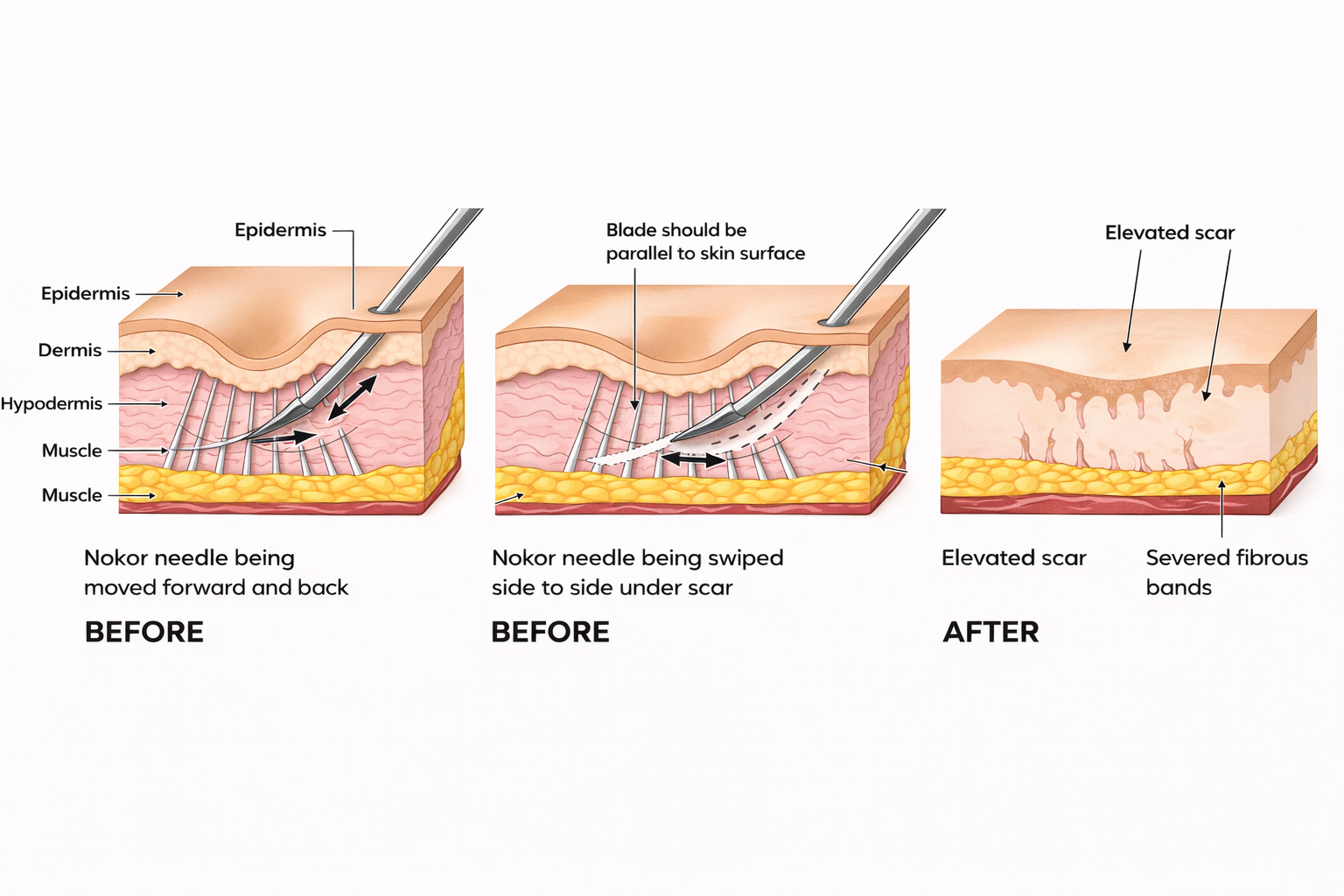 Acne Scar Subcision Revision Diagram